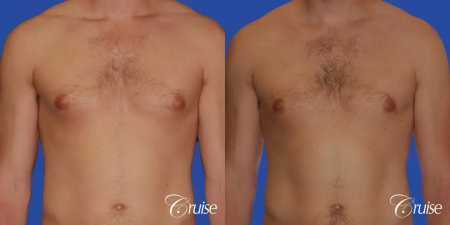 young adult with puffy nipple gets the best results with top gynecomastia surgeon - Before and After 1