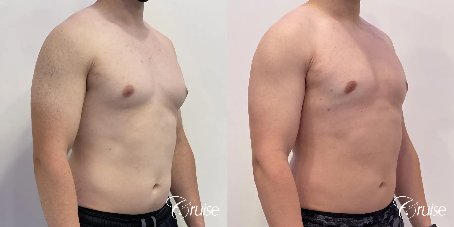 Gynecomastia: Patient 127 - Before and After 4