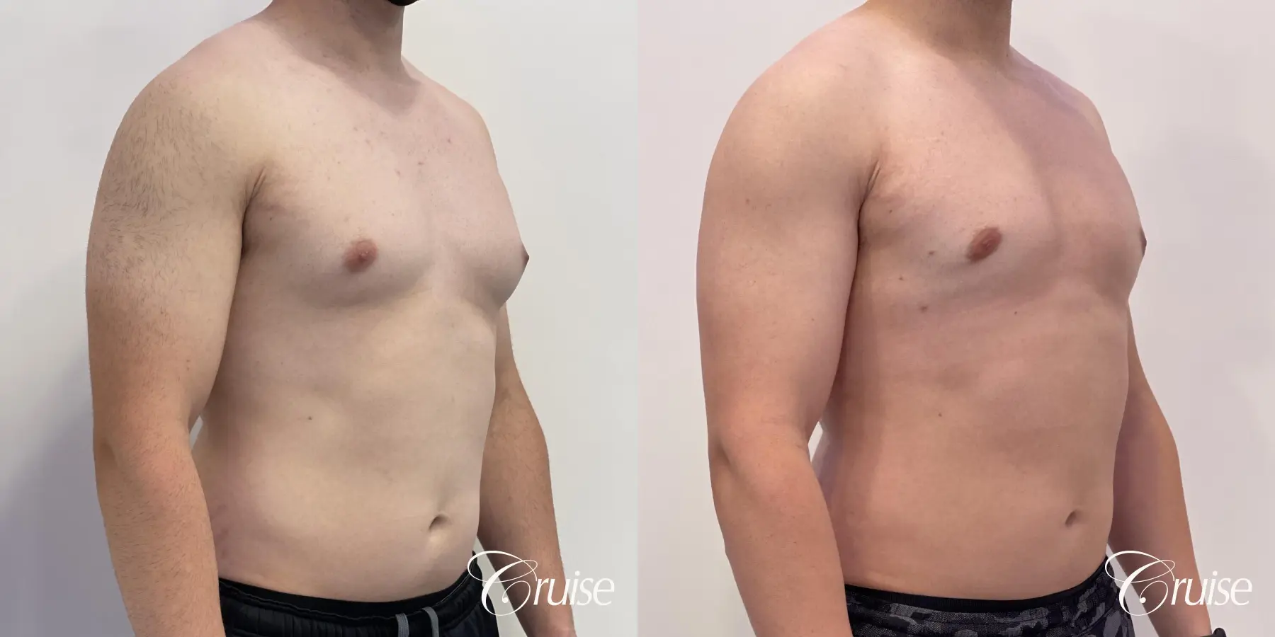 Gynecomastia: Patient 129 - Before and After 4