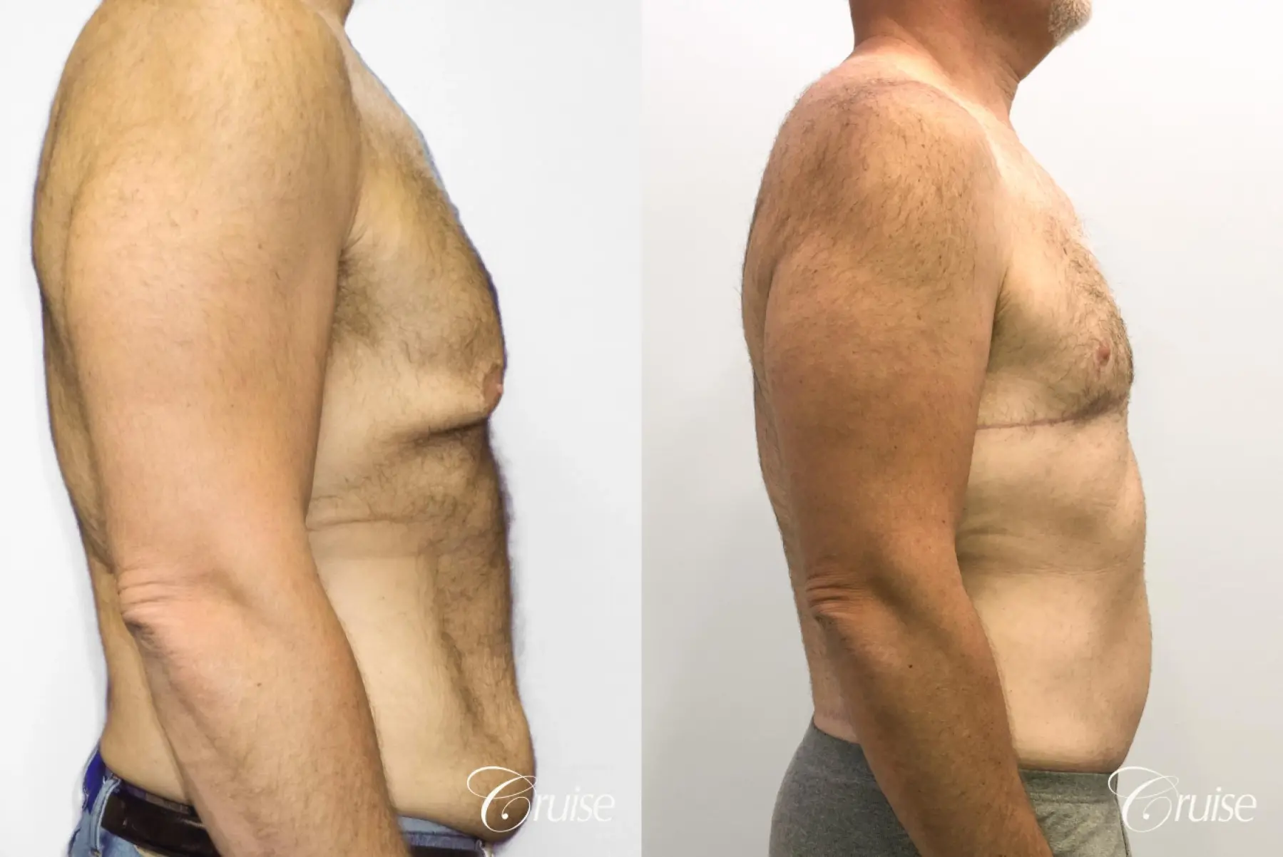 Gynecomastia: Patient 142 - Before and After 5