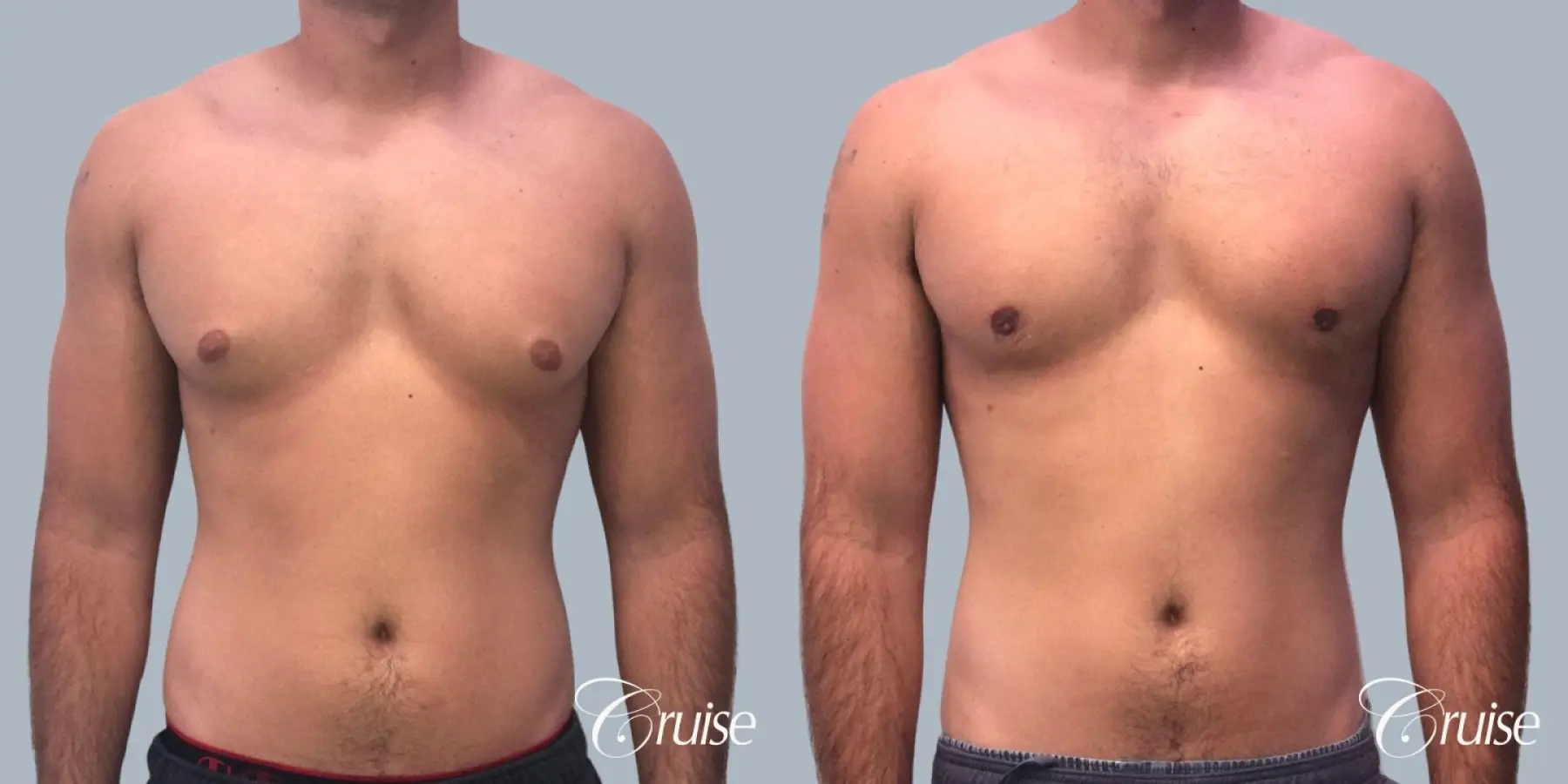 Gynecomastia: Patient 156 - Before and After 1