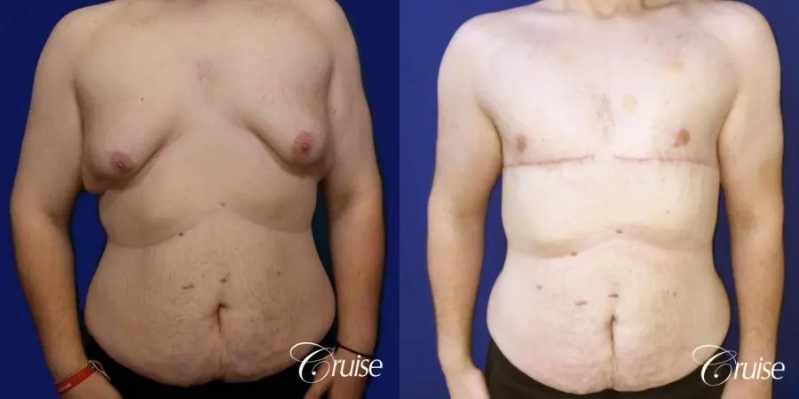 severe gynecomastia - Before and After 1