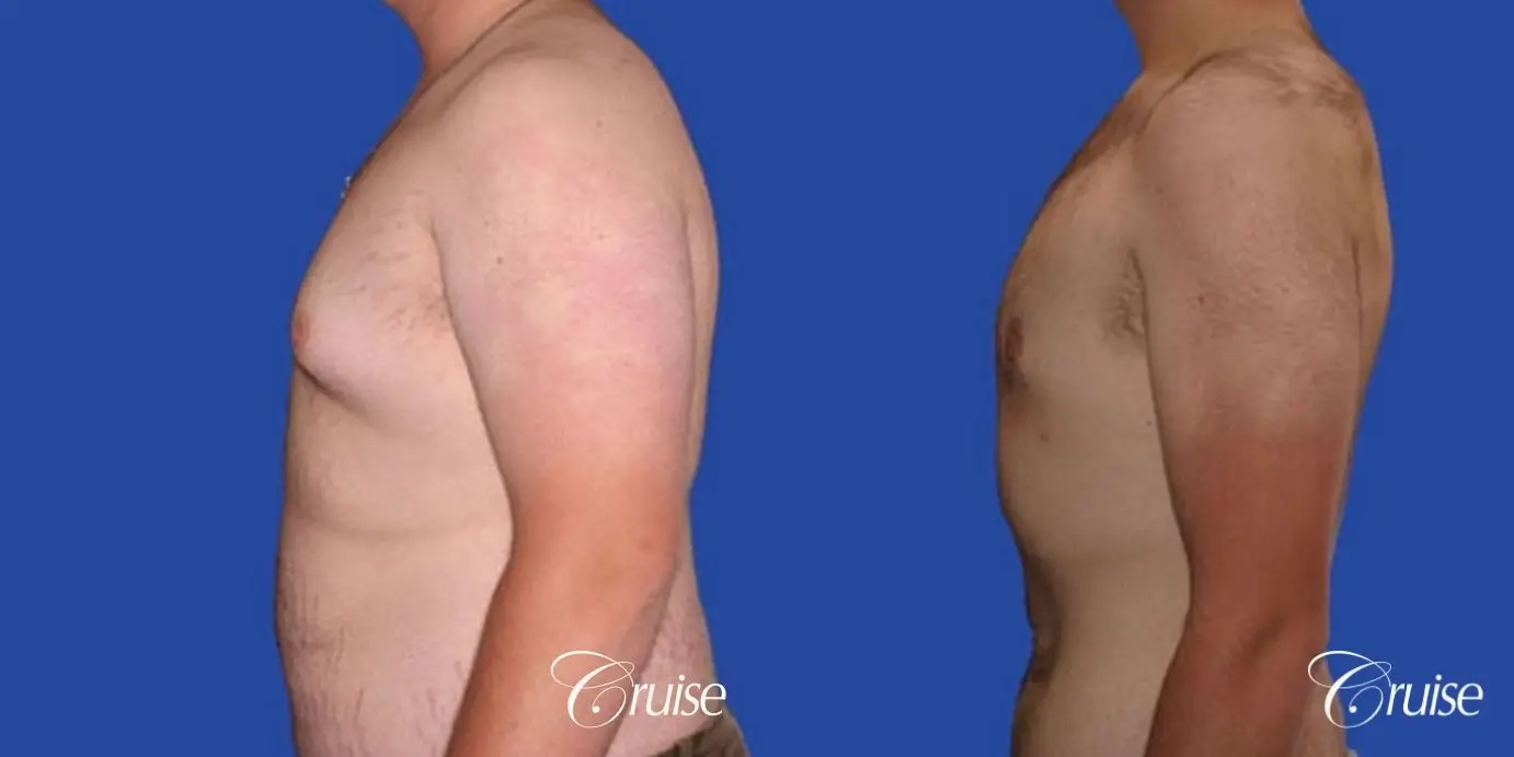 weight loss patient with gynecomastia - Before and After 2