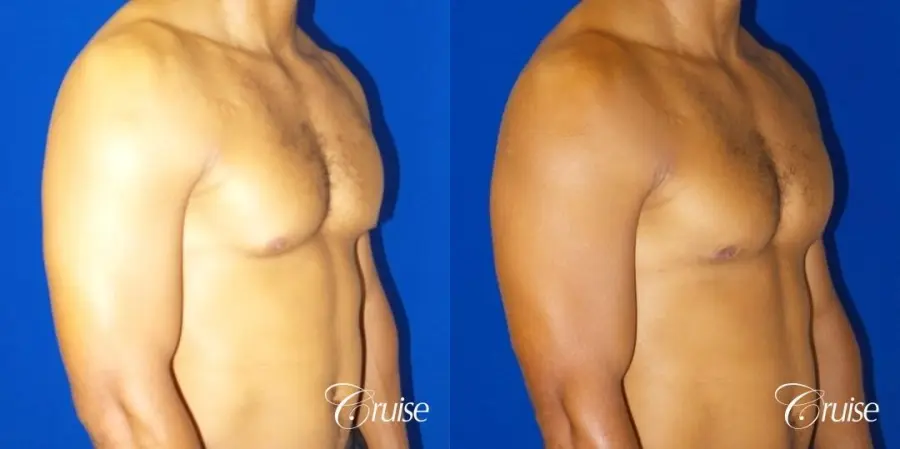 gynecomastia caused by testosterone - Before and After 2