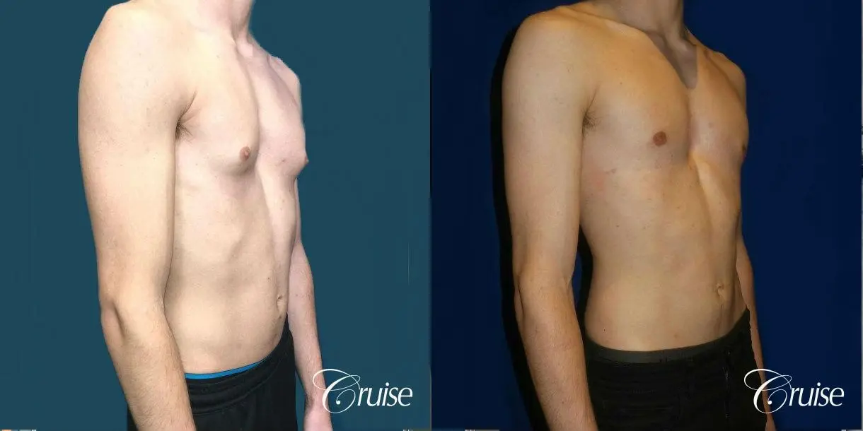 Top Gynecomastia Specialist Dr. Cruise - Before and After 5
