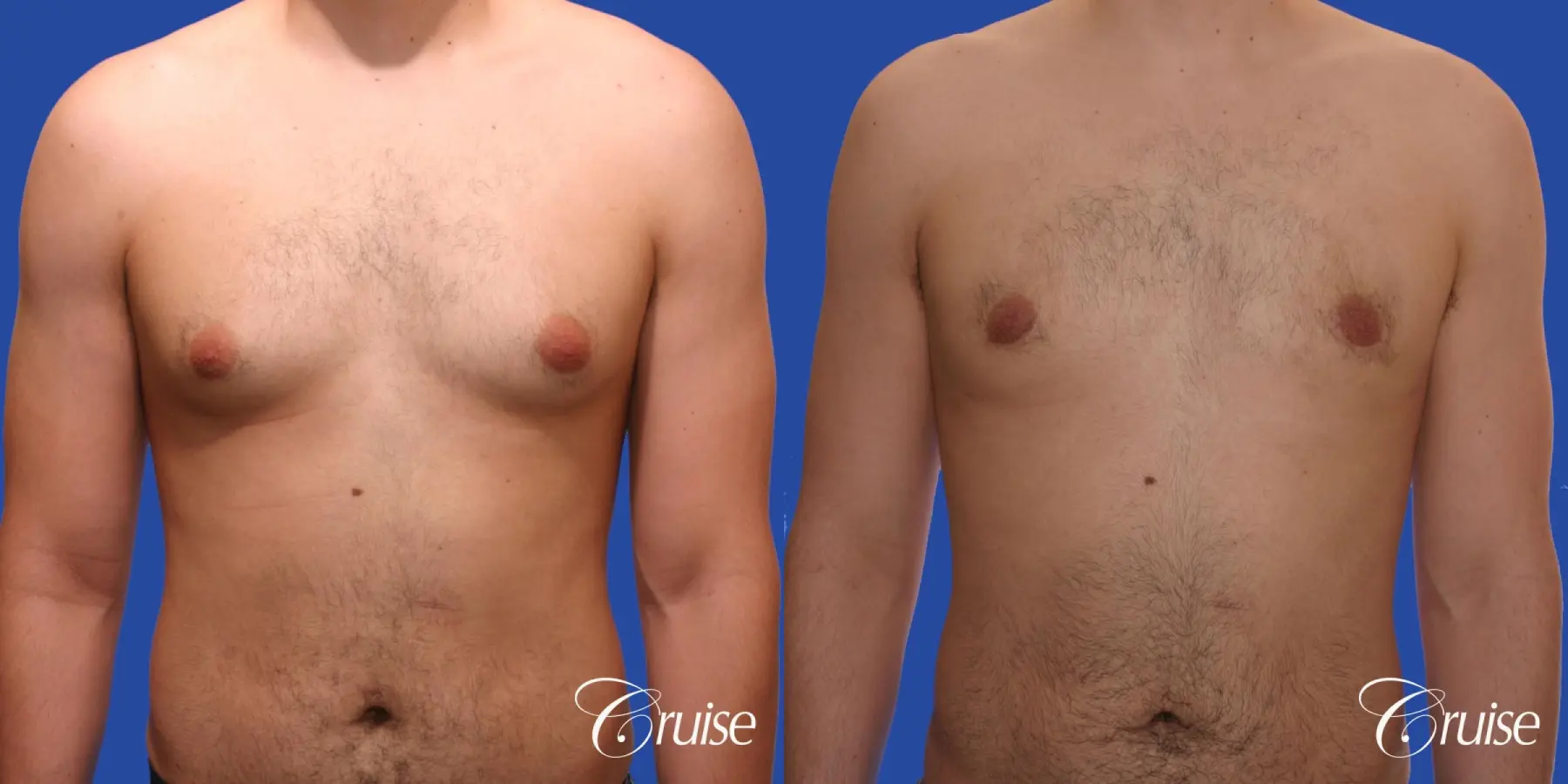 Type 2 Gynecomastia Young Adult - Before and After 1