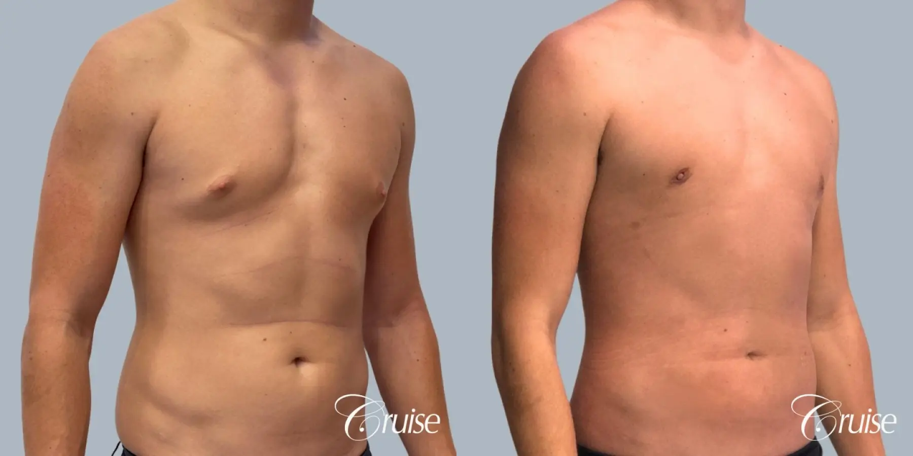 Gynecomastia: Patient 153 - Before and After 2