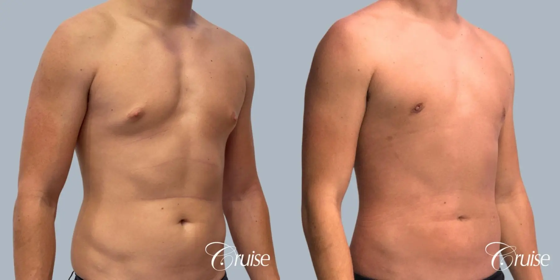 Gynecomastia: Patient 18 - Before and After 2