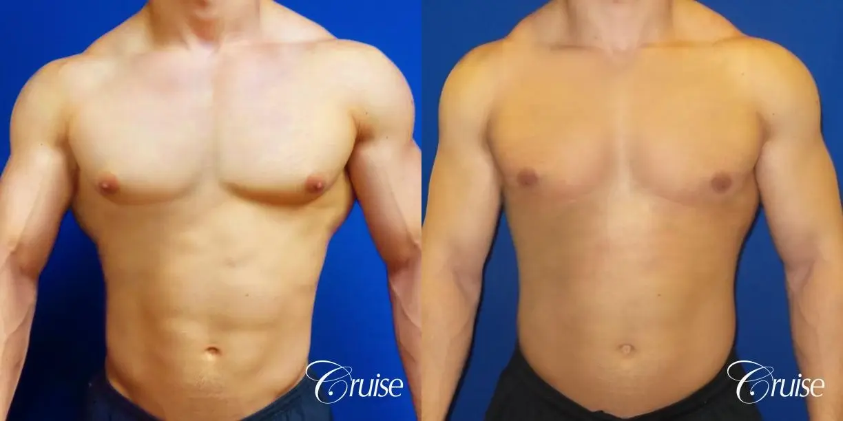 Type 1 Body Builder Puffy Nipple Correction - Before and After 1