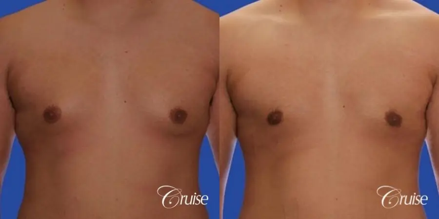 mild gyne on 24yr old adult - Before and After 1