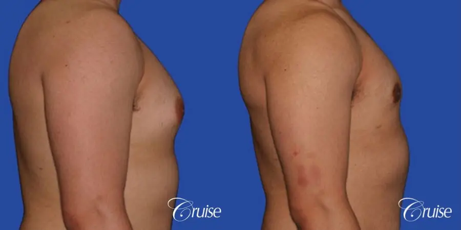 minor gyne young adult with best scars - Before and After 3