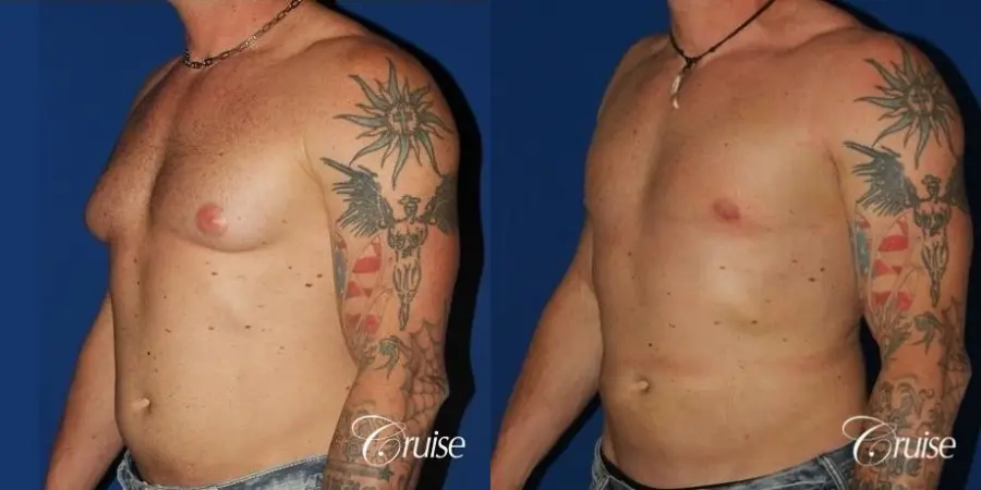 Athletic adult gynecomastia with glandular tissue removal - Before and After 2