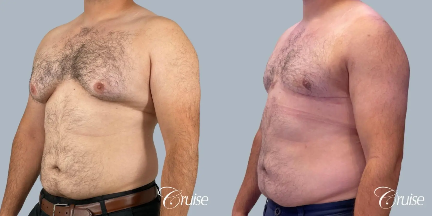 Gynecomastia: Patient 9 - Before and After 3
