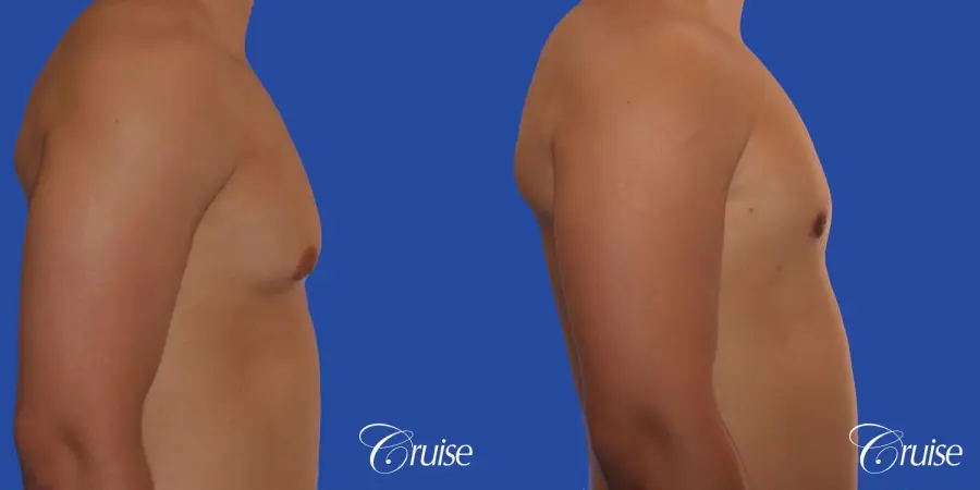mild gynecomastia with puffy nipple and areola incision - Before and After 3
