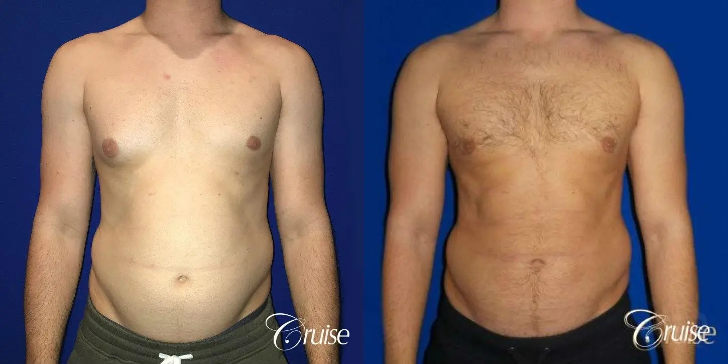 Type 2/3 Asymmetric Gynecomastia  - Before and After 1