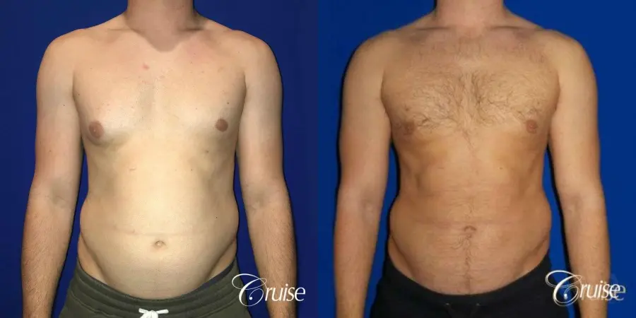 Type 2/3 Asymmetric Gynecomastia  - Before and After  