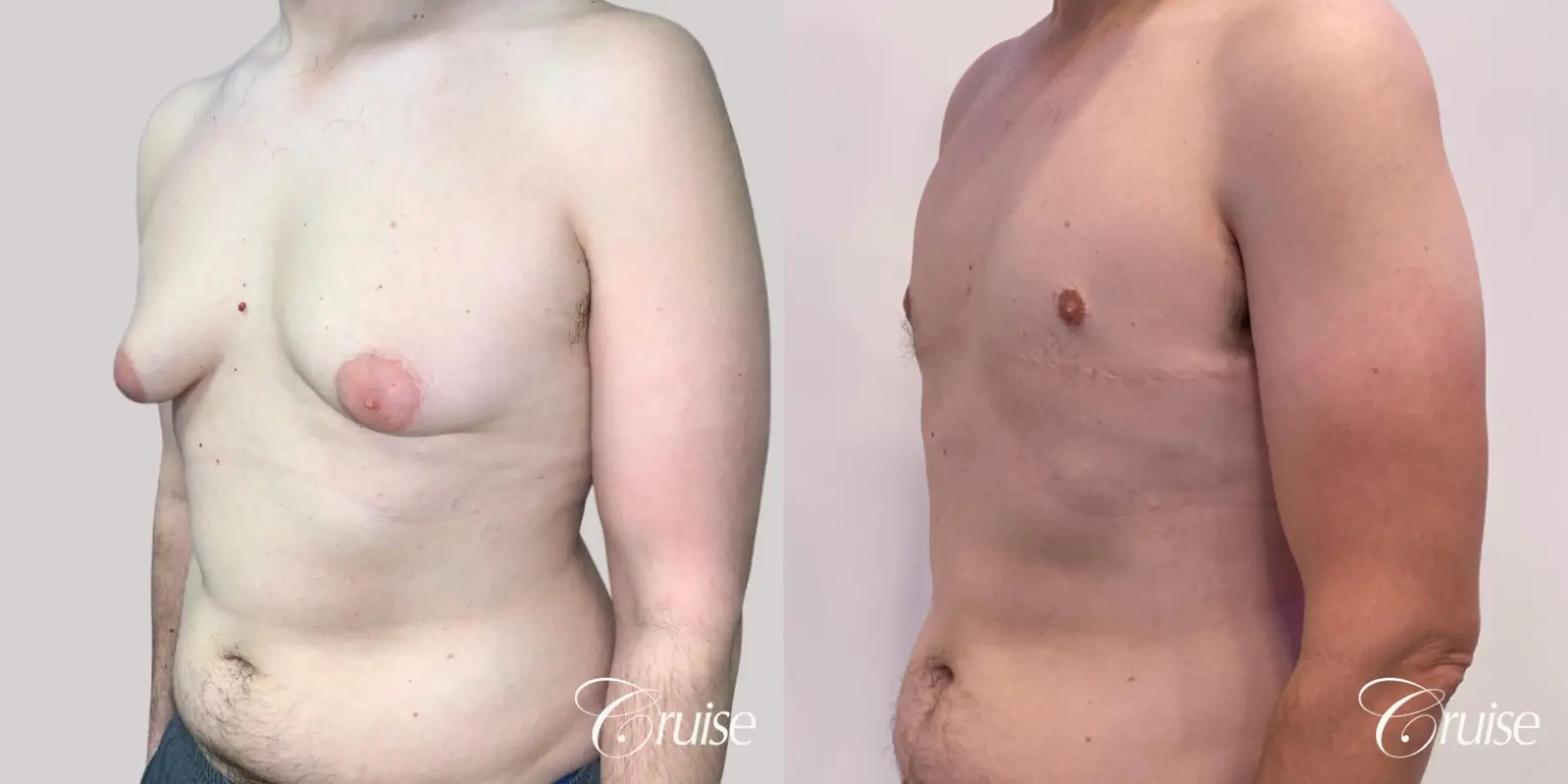 Gynecomastia: Patient 149 - Before and After 3