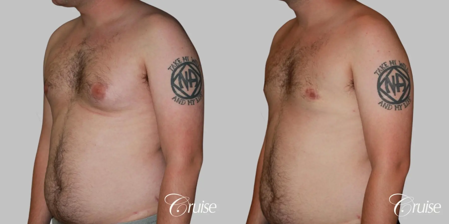 asymmetric gynecomastia moderate - Before and After 3