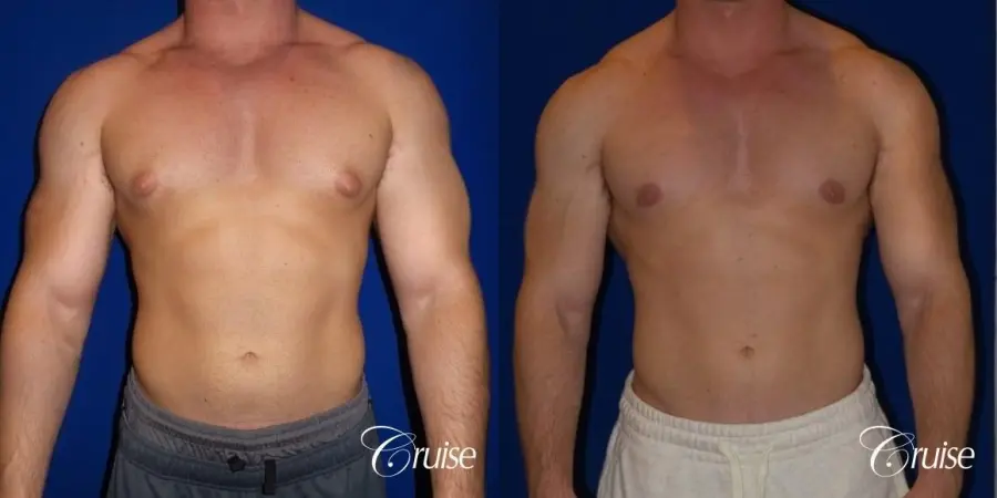Pictures of young bodybuilder with puffy nipples - Before and After 1