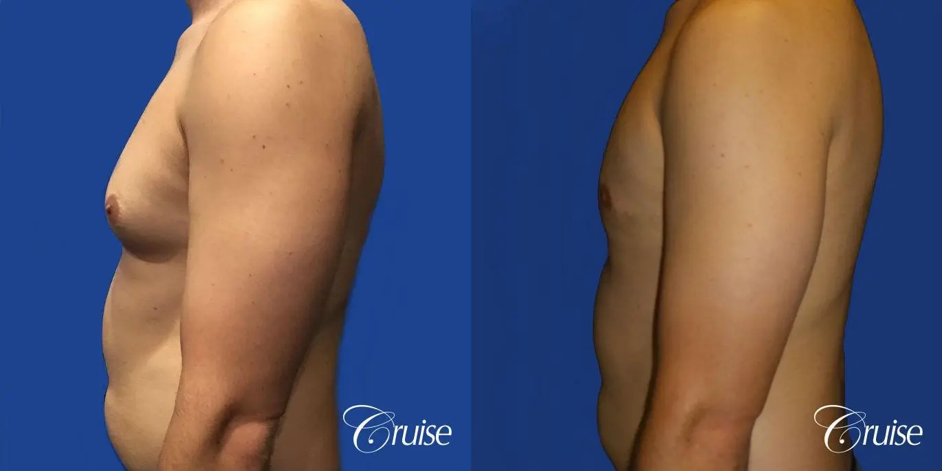 gyne before and after photos orange county ca - Before and After 3