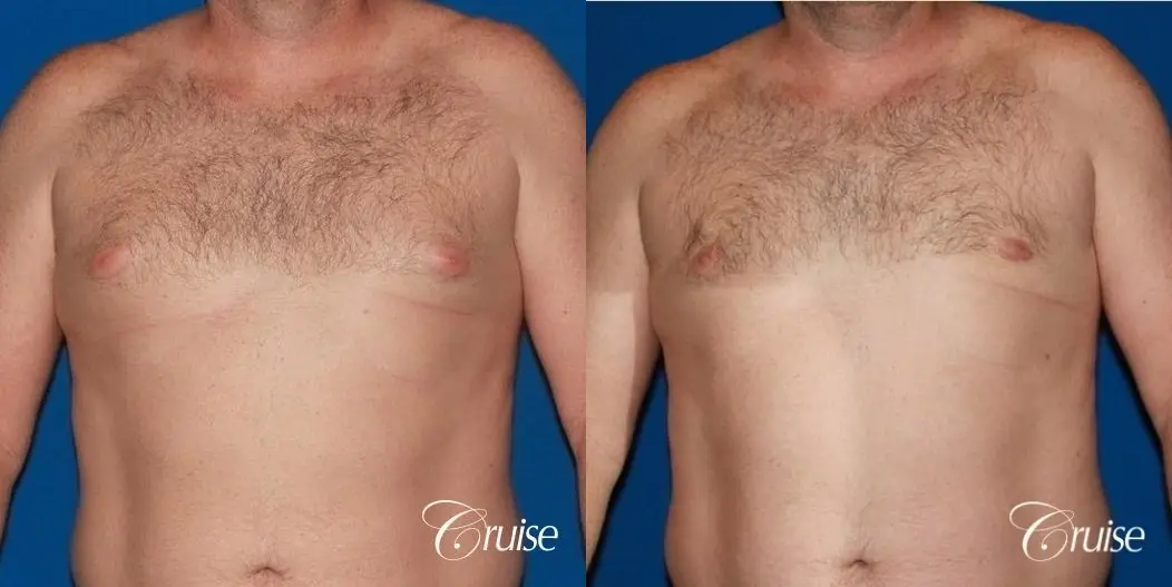 mild puffy nipple on 42 year old - Before and After 1