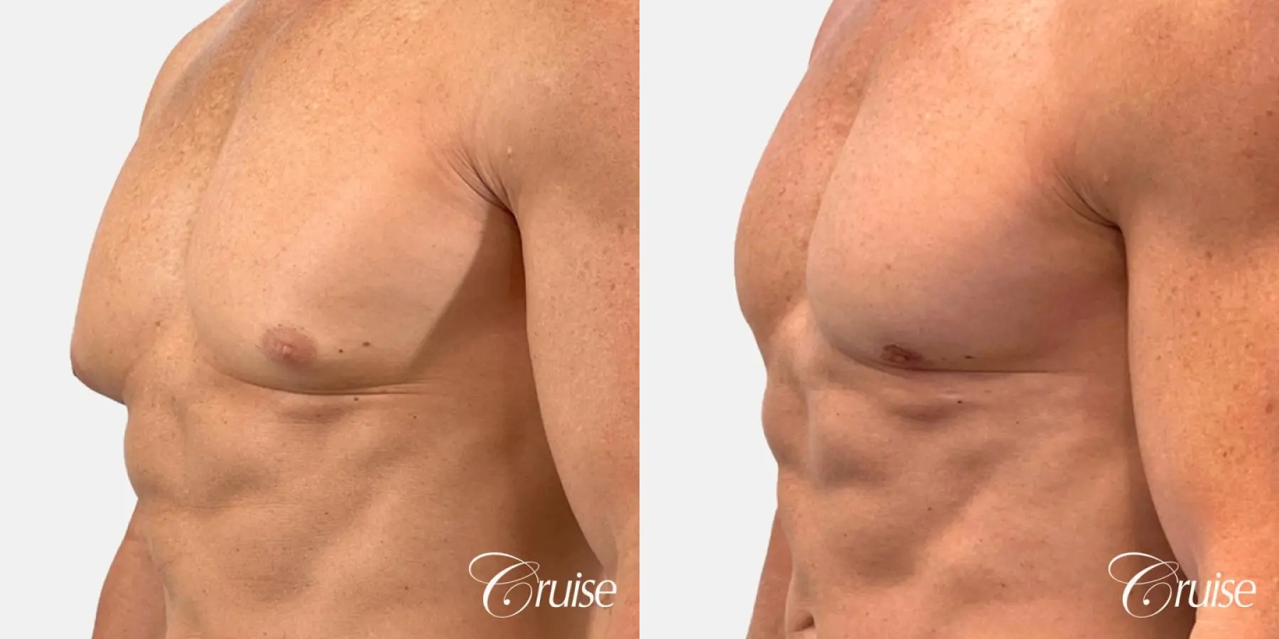 gynecomastia removal - Before and After 4