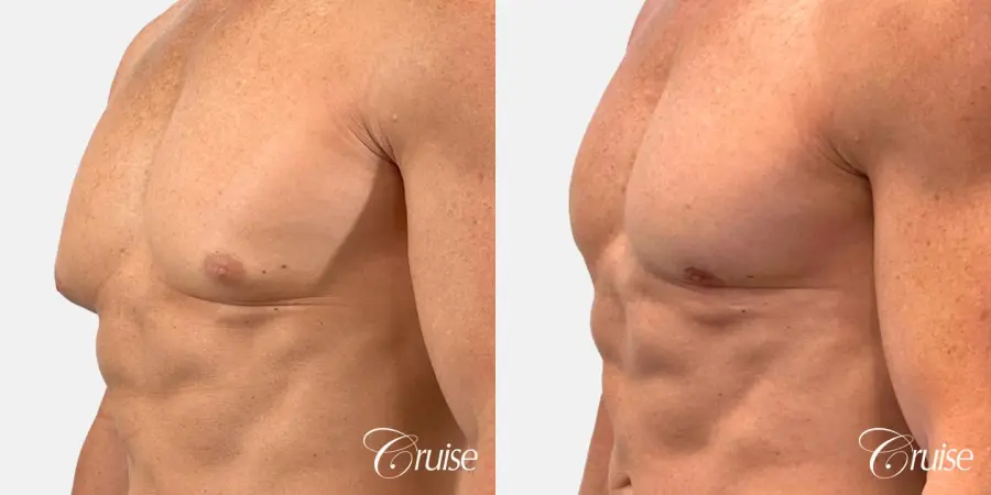 gynecomastia removal - Before and After 4