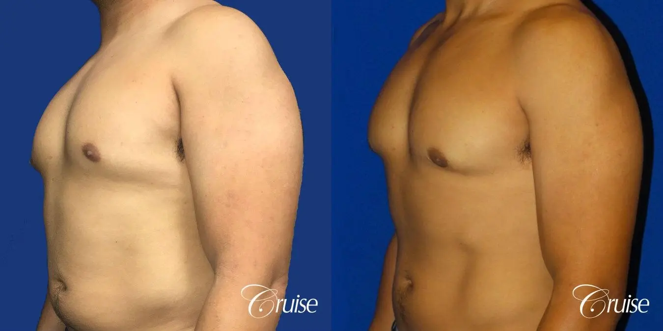 Type 2 Gynecomastia with Areola Incision - Before and After 2