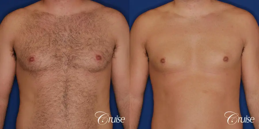 male patient has mild gynecomastia - Before and After 1
