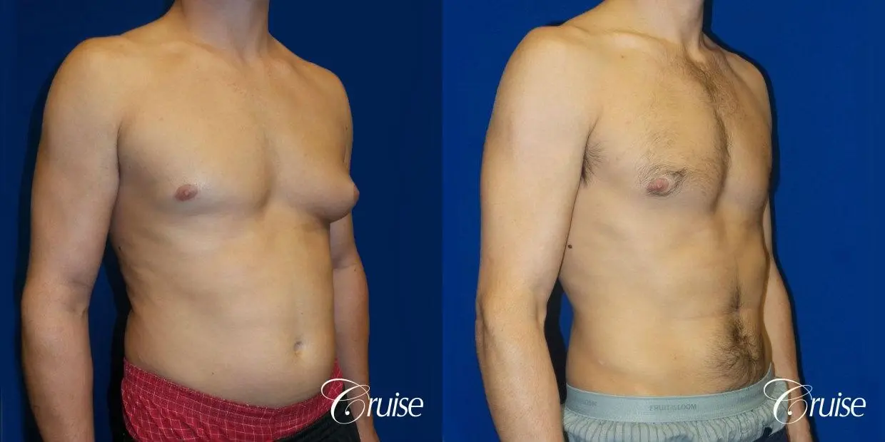 Unilateral gynecomastia - Before and After 2