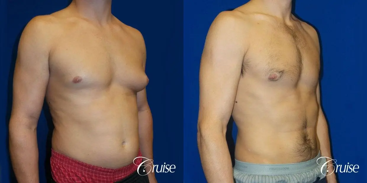 Gynecomastia Before and After 02