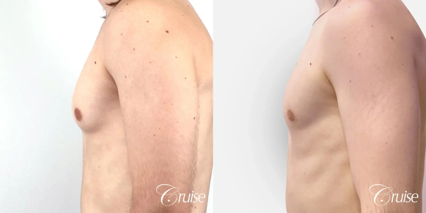 Type 1 Gynecomastia Removal - Before and After 3