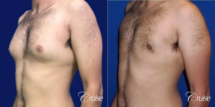 Moderate Gynecomastia Areola Incision - Before and After 3