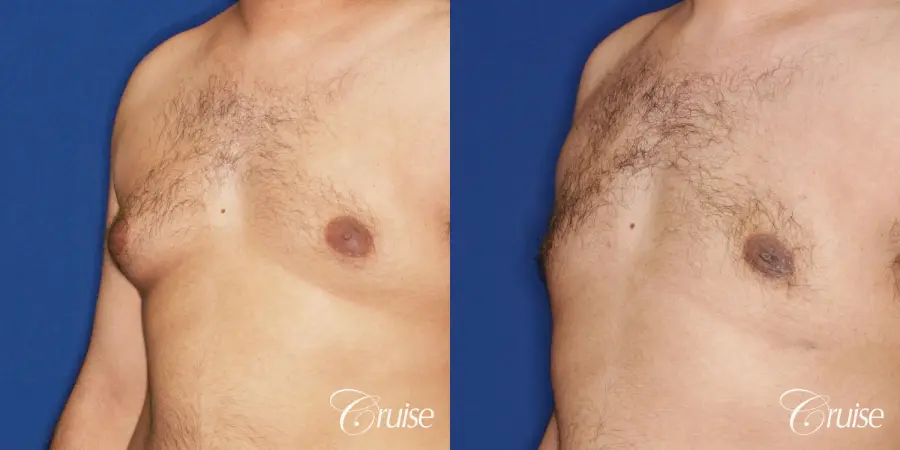 best scar on 32 gynecomastia patient - Before and After 2