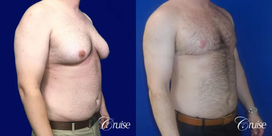 Severe Gynecomastia- Free nipple Graft - Before and After 3
