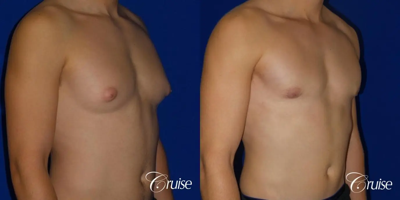 Mild Gynecomastia -Areola Incision - Before and After 4