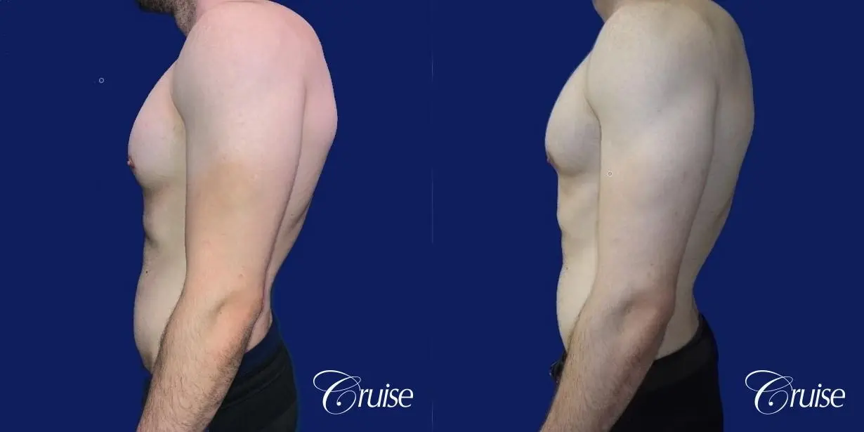 Moderate Gynecomastia -Areola Incision - Before and After 2