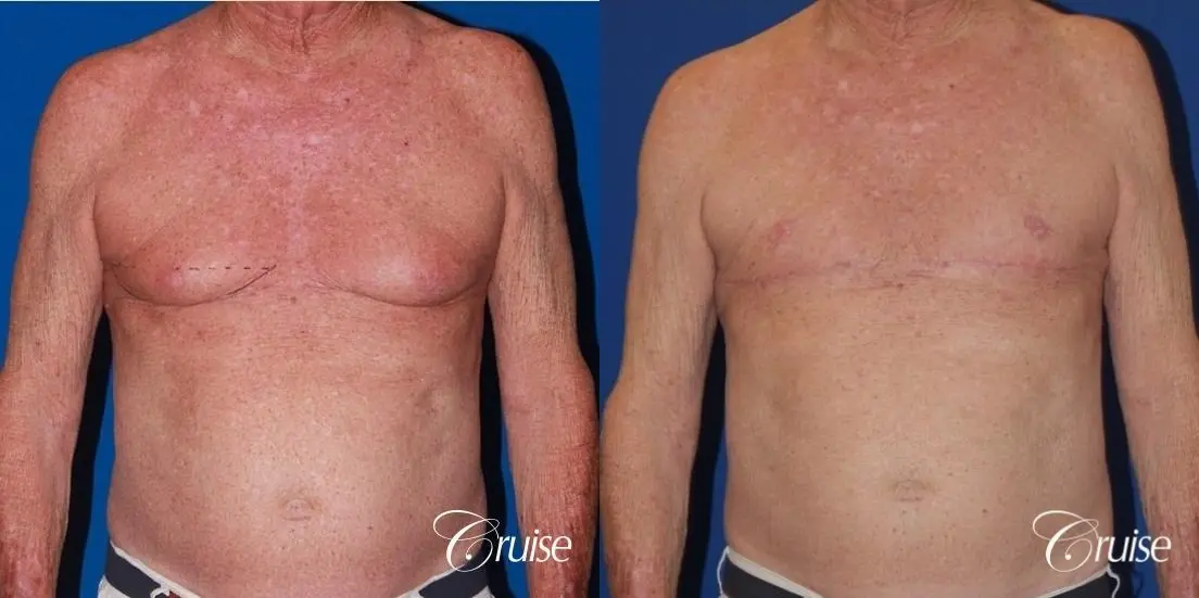 free nipple graft gynecomastia on aging man - Before and After 1