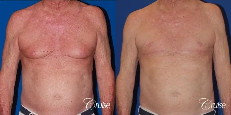 free nipple graft gynecomastia on aging man - Before and After 1