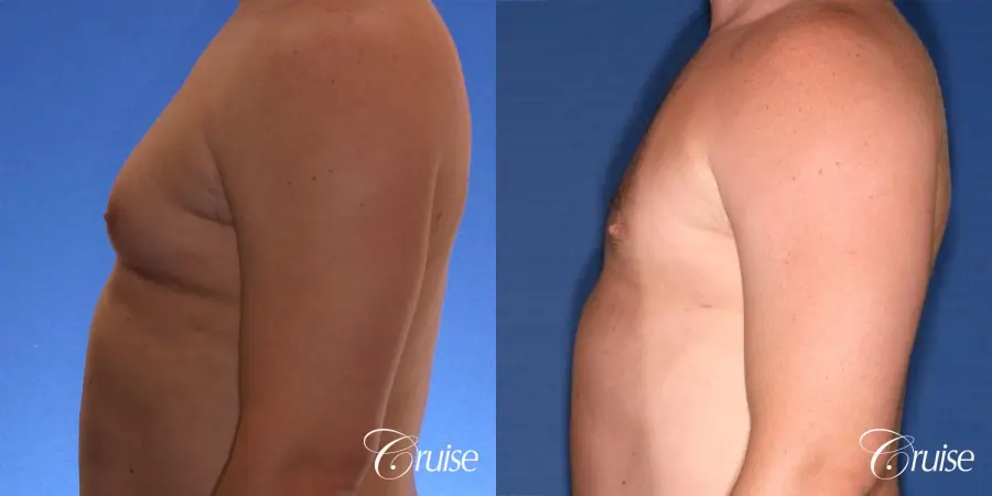 male adult with gynecomastia - Before and After 2