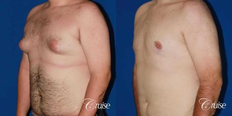moderate gynecomastia with pointy man boobs - Before and After 3