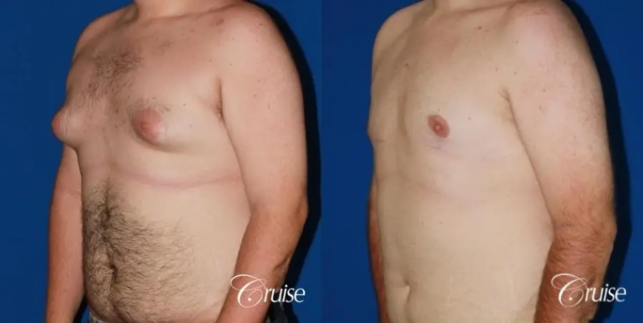 moderate gynecomastia with pointy man boobs - Before and After 3
