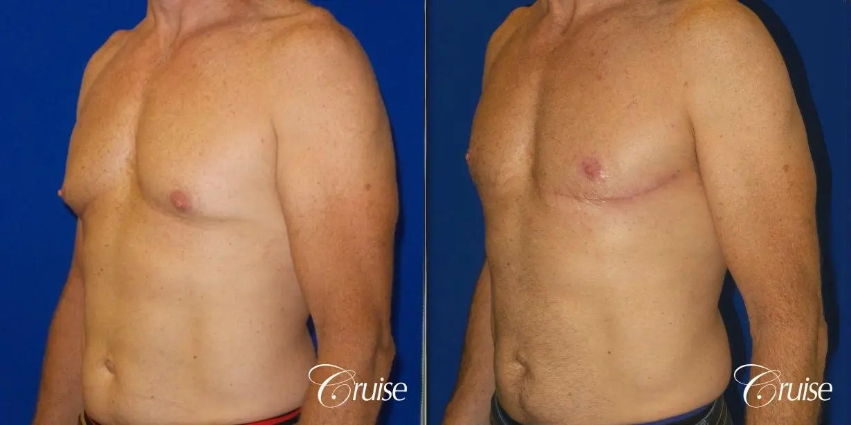 Top Gynecomastia surgeon Newport Beach - Before and After 2