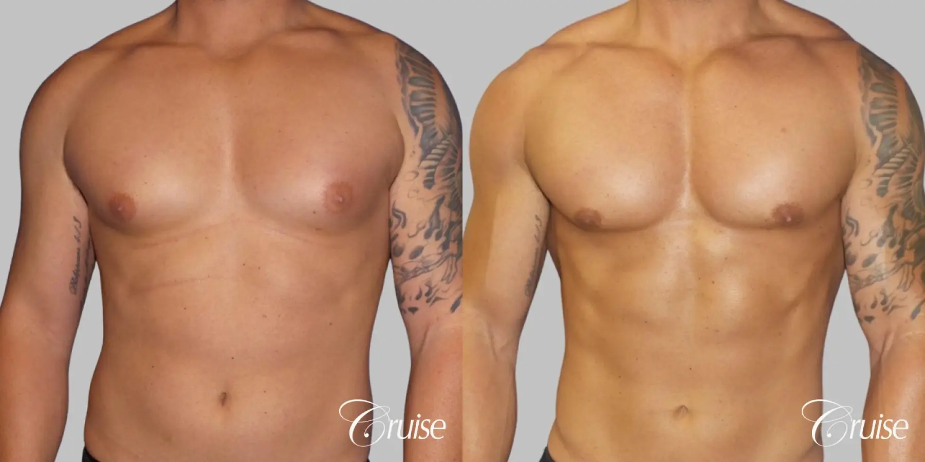 Gynecomastia puffy nipples cost - Before and After 1