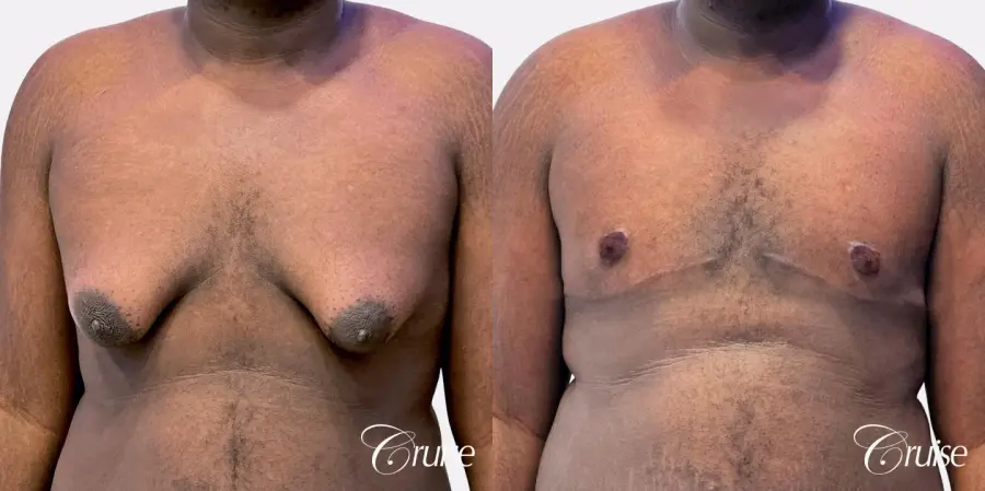 Gynecomastia Type 4 - Before and After 1