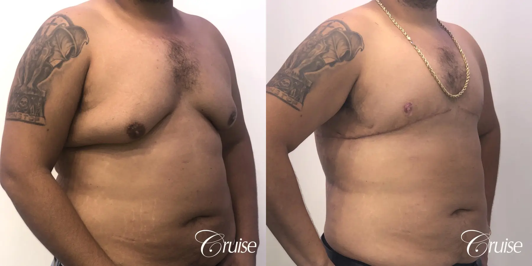 Gynecomastia: Patient 133 - Before and After 4