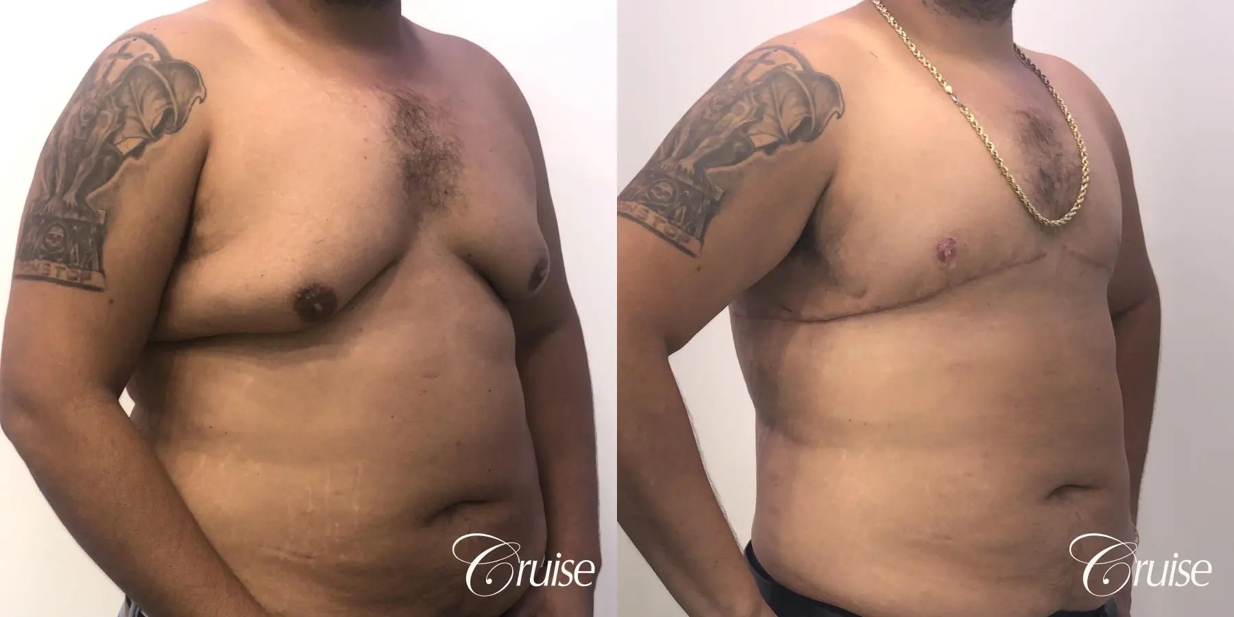 Gynecomastia: Patient 135 - Before and After 4