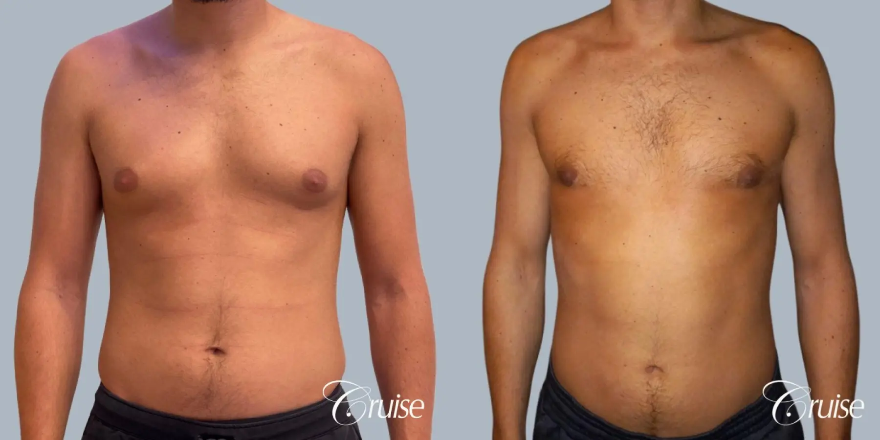 Gynecomastia: Patient 150 - Before and After 1