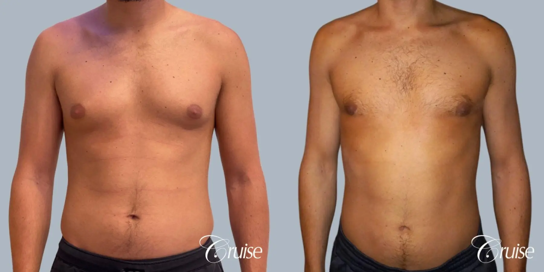 Gynecomastia: Patient 154 - Before and After 1