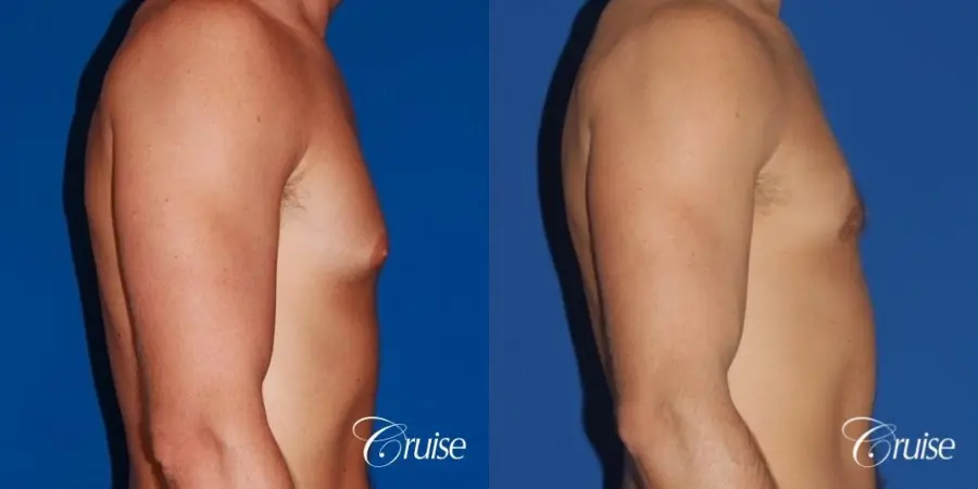 mild gyne on athletic adult - Before and After 2
